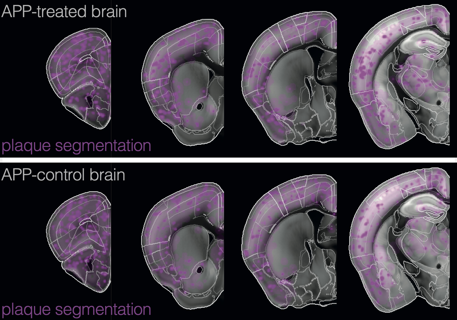 Brainwide Microglia & Plaque Quantification for Prime-Edited Sleep Restoration in Alzheimer's